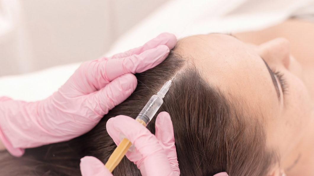 PRP for Hair Loss: What the Evidence Shows and Whether It Is Worth It