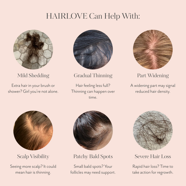 Six circular close-ups of mild shedding, thinning, widened part, visible scalp, patchy bald spots and severe hair loss
