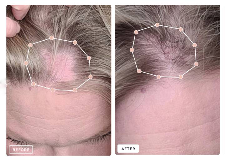 Before and after comparison of hair growth, showing significant improvement in hair density.
