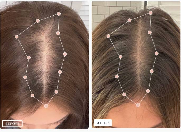 Before and after comparison of hair treatment results, showing hairline improvement.