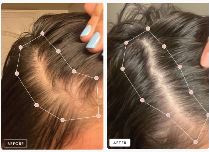 Before and after comparison of hair growth, showing increased density and coverage.