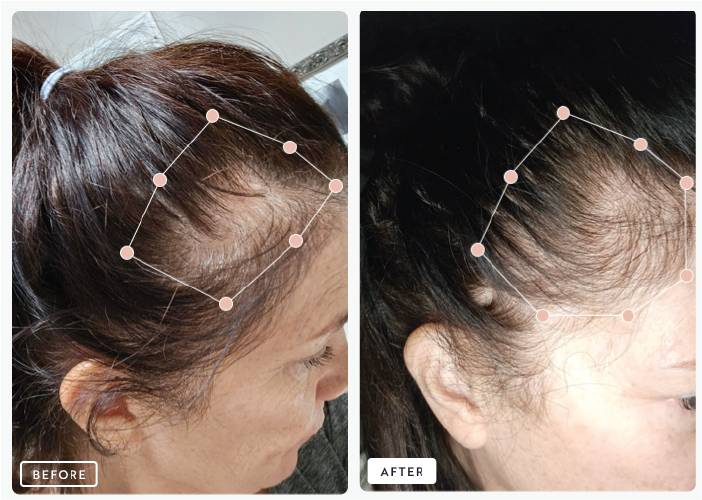 Before and after comparison of hair growth showing increased density and improved hairline.