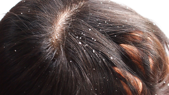 Close-up of a dark-haired person’s scalp showing white dandruff flakes along the part line