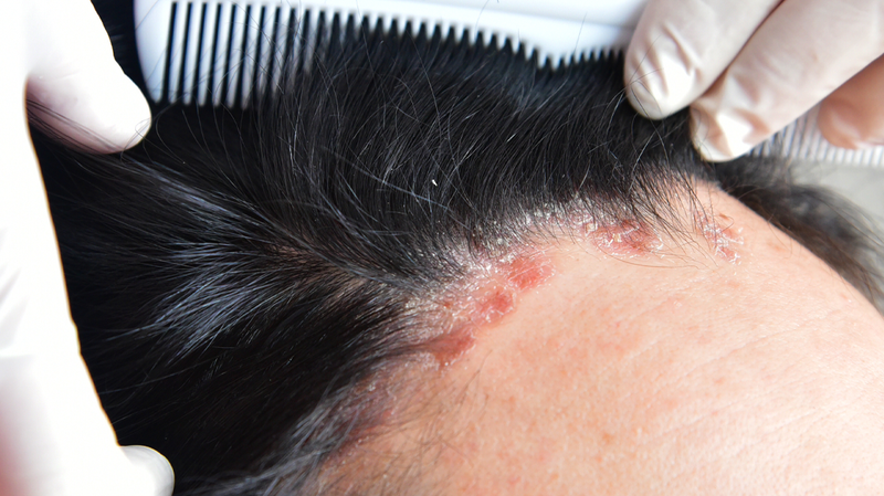Scalp Fungus and Hair Loss: Is a Fungal Infection Causing Your Shedding?