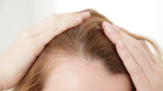 Woman parting red-brown hair to reveal thinning hairline and receding temples against a white background