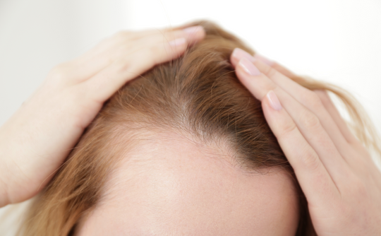 Woman parting her light-colored hair with both hands to reveal thinning at the temples and a receding hairline
