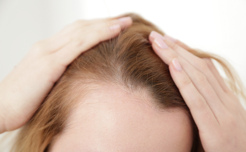 Woman parting her light-colored hair with both hands to reveal thinning at the temples and a receding hairline