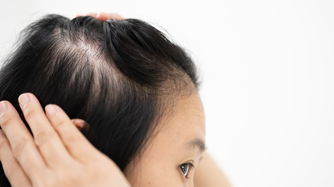 Female Pattern Baldness: What It Actually Is, Why It Happens, and What Works