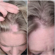 Before and after comparison of a person's scalp showing increased hair density and reduced bald spots.